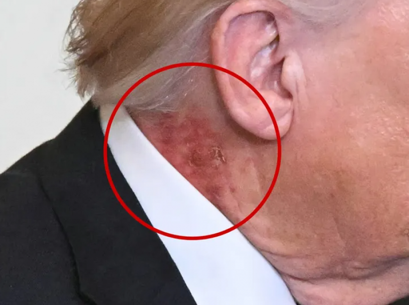 โซเชียลแห่แชร์ ทรัมป์เป็นโรคอะไร?มีแผลผื่นแดงหนารอบลำคอ
