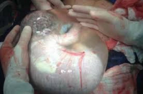 พบทารกยังห่อตัวในถุงน้ำคร่ำก้อนใหญ่ หลังรับการผ่าท้องจากครรภ์มารดา