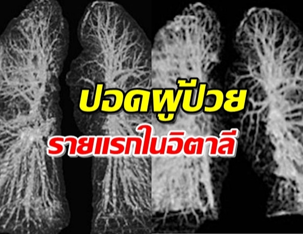 เผยภาพ ปอดผู้ป่วยโควิด-19 รายแรกในอิตาลี