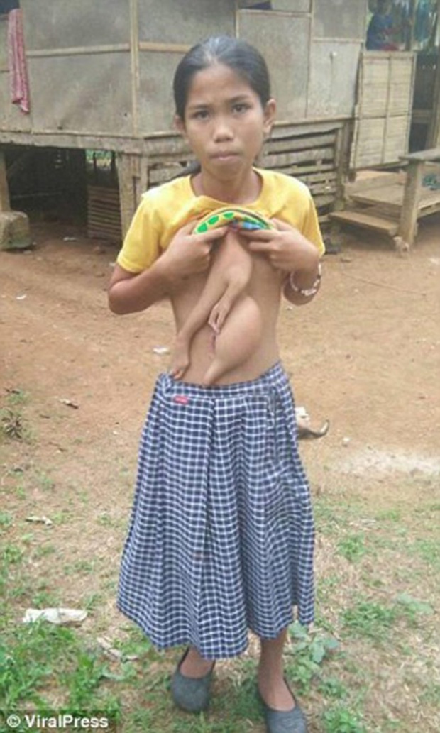 น่ากลัว!!! ด.ญ.ฟิลิปปินส์ แขนแฝดติดอยู่ที่ตัว เตรียมมาผ่าตัดในเมืองไทย