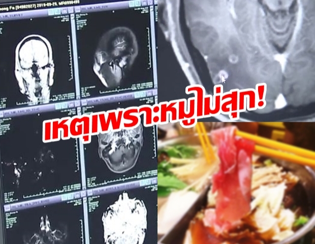 กินหมูหม้อไฟไม่สุก 700 “พยาธิตัวตืด” เข้าสมอง-ปอด-ช่องอก