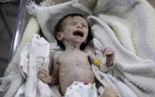 ภาพสลดสะเทือนใจ..ทารกในสมรภูมิซีเรียผอมแกรน สะท้อนภาวะขาดสารอาหาร