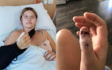 หญิงสาวกัดเล็บมือจนเกลี้ยง ลุกลามจนกลายเป็นมะเร็งผิวหนัง สุดท้ายต้องตัดนิ้วโป้งทิ้ง!!