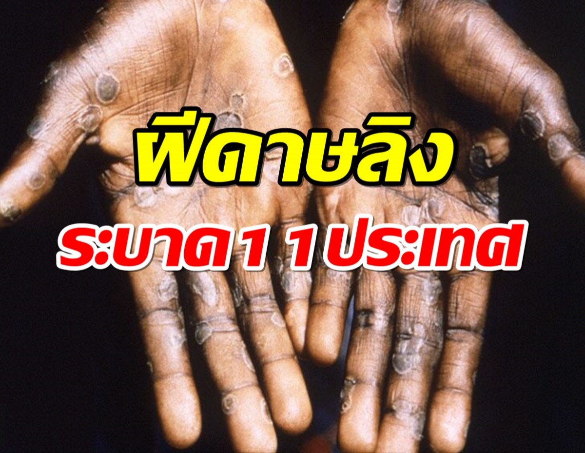 ฝีดาษลิง ระบาดแล้ว11 ประเทศ เล็งฉีดวัคซีนชายรักชาย